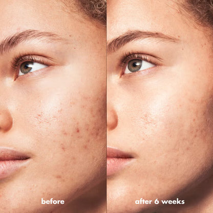 e.l.f Blemish Breakthrough Fighting Spot Gel